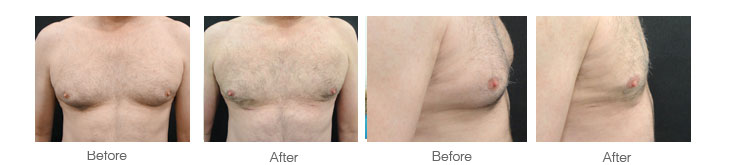 male breast reduction  man boobs reduced using laser surgery less invasive than liposuction and deliverering results